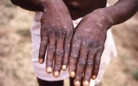 Rwanda Reports Four Monkeypox Cases: Health Ministry Takes Action
