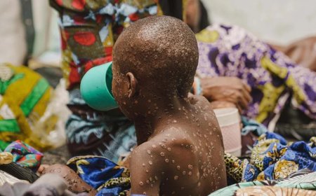 Outbreak of Monkeypox in South Kivu Province, DRC Cases Fleeing Hospitals Due to Food crunches