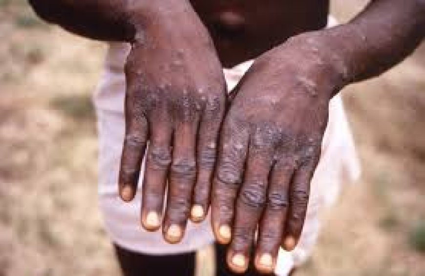 Rwanda Reports Four Monkeypox Cases: Health Ministry Takes Action