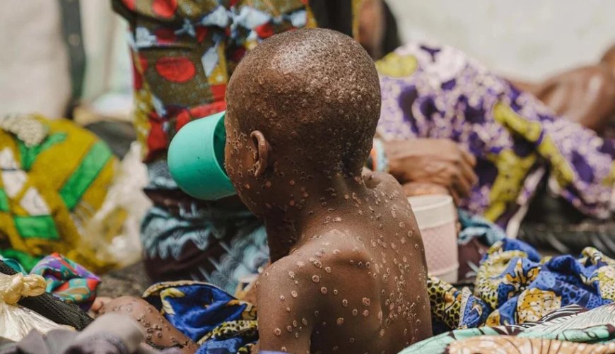 Outbreak of Monkeypox in South Kivu Province, DRC Cases Fleeing Hospitals Due to Food crunches